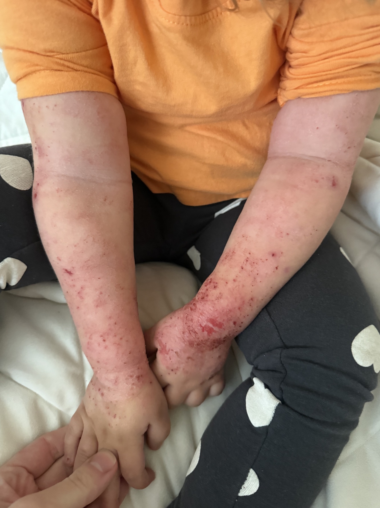 Baby eczema before starting protocol — red, inflamed patches